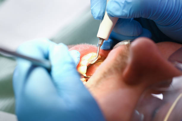 Best Emergency Treatment for Dental Infections or Abscesses in Fairview, CA